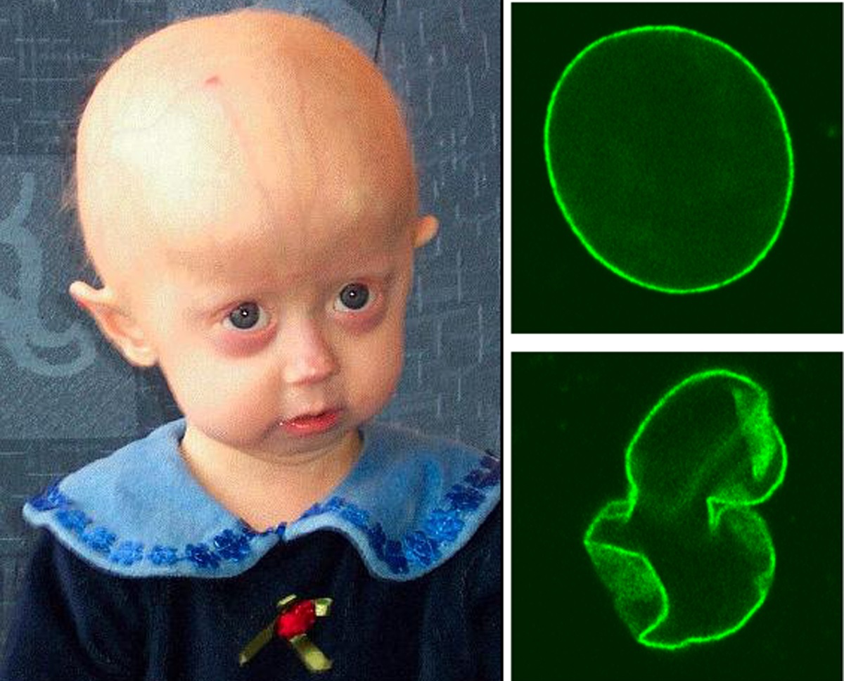 ¿Qué es la progeria? La enfermedad que ha matado a Sammy Basso a los 28 años